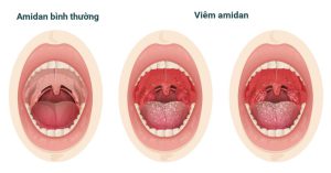Viem amidan sn